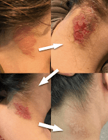 Neck rash in three angles